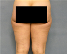 Liposuction Before Photo by Ellen Janetzke, MD; Bloomfield Hills, MI - Case 24469