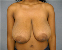 Breast Reduction Before Photo by Ellen Janetzke, MD; Bloomfield Hills, MI - Case 24470