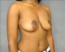 Breast Reduction After Photo by Ellen Janetzke, MD; Bloomfield Hills, MI - Case 24470