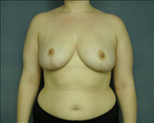 Breast Reduction After Photo by Ellen Janetzke, MD; Bloomfield Hills, MI - Case 24471