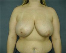Breast Reduction Before Photo by Ellen Janetzke, MD; Bloomfield Hills, MI - Case 24471