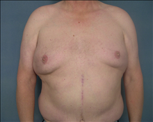 Male Breast Reduction Before Photo by Ellen Janetzke, MD; Bloomfield Hills, MI - Case 24472