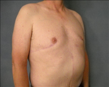 Male Breast Reduction After Photo by Ellen Janetzke, MD; Bloomfield Hills, MI - Case 24472