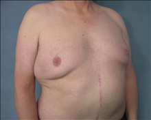 Male Breast Reduction Before Photo by Ellen Janetzke, MD; Bloomfield Hills, MI - Case 24472