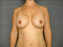 Breast Augmentation After Photo by Ellen Janetzke, MD; Bloomfield Hills, MI - Case 24506