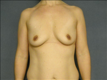 Breast Augmentation Before Photo by Ellen Janetzke, MD; Bloomfield Hills, MI - Case 24506