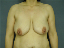 Breast Augmentation Before Photo by Ellen Janetzke, MD; Bloomfield Hills, MI - Case 24507