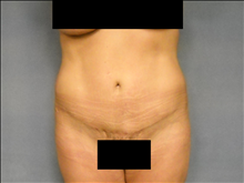 Tummy Tuck After Photo by Ellen Janetzke, MD; Bloomfield Hills, MI - Case 24508