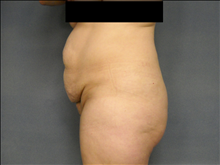 Tummy Tuck Before Photo by Ellen Janetzke, MD; Bloomfield Hills, MI - Case 24508
