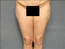 Liposuction Before Photo by Ellen Janetzke, MD; Bloomfield Hills, MI - Case 24509