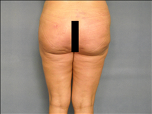 Liposuction After Photo by Ellen Janetzke, MD; Bloomfield Hills, MI - Case 24509