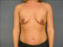 Breast Augmentation Before Photo by Ellen Janetzke, MD; Bloomfield Hills, MI - Case 24678