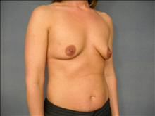 Breast Augmentation Before Photo by Ellen Janetzke, MD; Bloomfield Hills, MI - Case 24678