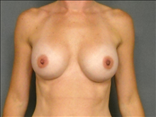 Breast Augmentation After Photo by Ellen Janetzke, MD; Bloomfield Hills, MI - Case 24687