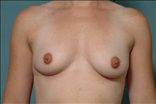 Breast Augmentation Before Photo by Ellen Janetzke, MD; Bloomfield Hills, MI - Case 24687