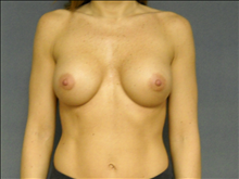 Breast Augmentation After Photo by Ellen Janetzke, MD; Bloomfield Hills, MI - Case 24692