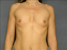 Breast Augmentation Before Photo by Ellen Janetzke, MD; Bloomfield Hills, MI - Case 24692