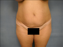 Tummy Tuck Before Photo by Ellen Janetzke, MD; Bloomfield Hills, MI - Case 24715