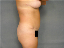 Tummy Tuck After Photo by Ellen Janetzke, MD; Bloomfield Hills, MI - Case 24715