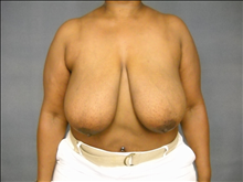 Breast Reduction Before Photo by Ellen Janetzke, MD; Bloomfield Hills, MI - Case 24796