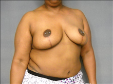Breast Reduction After Photo by Ellen Janetzke, MD; Bloomfield Hills, MI - Case 24796