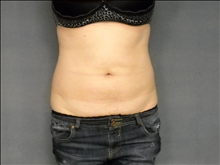 Liposuction After Photo by Ellen Janetzke, MD; Bloomfield Hills, MI - Case 24808