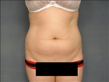 Liposuction Before Photo by Ellen Janetzke, MD; Bloomfield Hills, MI - Case 24808