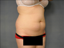 Liposuction Before Photo by Ellen Janetzke, MD; Bloomfield Hills, MI - Case 24808