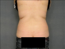 Liposuction After Photo by Ellen Janetzke, MD; Bloomfield Hills, MI - Case 24809