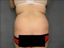 Liposuction Before Photo by Ellen Janetzke, MD; Bloomfield Hills, MI - Case 24809