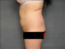 Liposuction Before Photo by Ellen Janetzke, MD; Bloomfield Hills, MI - Case 24809