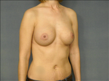 Breast Augmentation After Photo by Ellen Janetzke, MD; Bloomfield Hills, MI - Case 25133