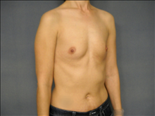 Breast Augmentation Before Photo by Ellen Janetzke, MD; Bloomfield Hills, MI - Case 25133