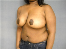 Breast Reduction After Photo by Ellen Janetzke, MD; Bloomfield Hills, MI - Case 25135