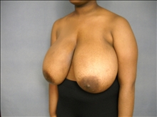 Breast Reduction Before Photo by Ellen Janetzke, MD; Bloomfield Hills, MI - Case 25135