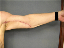 Arm Lift After Photo by Ellen Janetzke, MD; Bloomfield Hills, MI - Case 25137