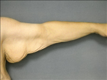 Arm Lift Before Photo by Ellen Janetzke, MD; Bloomfield Hills, MI - Case 25137