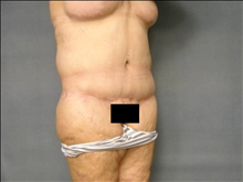 Tummy Tuck After Photo by Ellen Janetzke, MD; Bloomfield Hills, MI - Case 25139