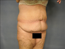 Tummy Tuck Before Photo by Ellen Janetzke, MD; Bloomfield Hills, MI - Case 25139