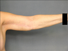 Arm Lift After Photo by Ellen Janetzke, MD; Bloomfield Hills, MI - Case 25140