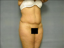Body Contouring After Photo by Ellen Janetzke, MD; Bloomfield Hills, MI - Case 25507