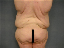 Body Contouring Before Photo by Ellen Janetzke, MD; Bloomfield Hills, MI - Case 25508