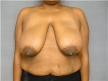 Breast Reduction Before Photo by Ellen Janetzke, MD; Bloomfield Hills, MI - Case 25784
