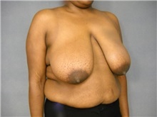 Breast Reduction Before Photo by Ellen Janetzke, MD; Bloomfield Hills, MI - Case 25784