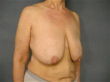 Breast Reduction Before Photo by Ellen Janetzke, MD; Bloomfield Hills, MI - Case 25792