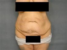 Body Contouring Before Photo by Ellen Janetzke, MD; Bloomfield Hills, MI - Case 25793