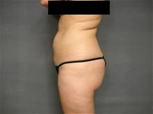Liposuction Before Photo by Ellen Janetzke, MD; Bloomfield Hills, MI - Case 25794
