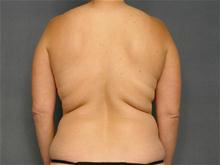 Liposuction Before Photo by Ellen Janetzke, MD; Bloomfield Hills, MI - Case 25794