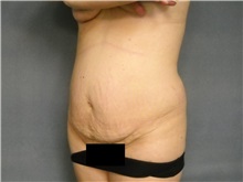 Tummy Tuck Before Photo by Ellen Janetzke, MD; Bloomfield Hills, MI - Case 25796