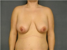 Breast Lift Before Photo by Ellen Janetzke, MD; Bloomfield Hills, MI - Case 25797